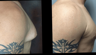 Gyno Picture 1