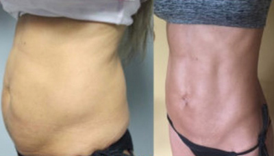 Flatter Stomach Picture 1