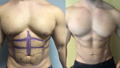 Chiseled Abs + Gyno – Male Breast Reduction