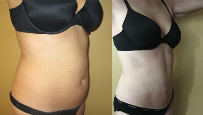 Flatter Stomach Picture 2