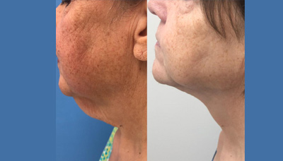 Rejuvenated Neck