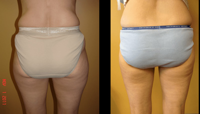 Thinner Thighs Picture 2