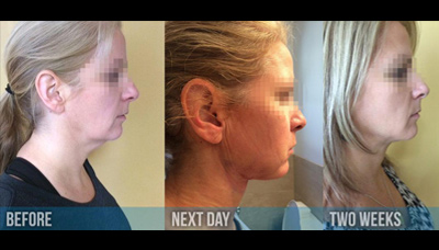 Rejuvenated Face & Neck Picture 3