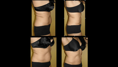 Flatter Stomach Picture 4