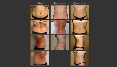 Flatter Stomach – Carved Abs
