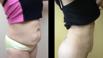 Flatter Stomach Picture 5