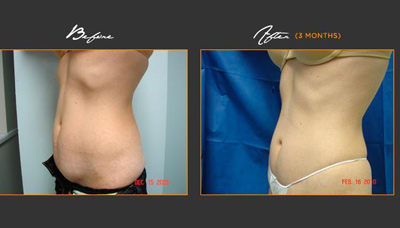Flatter Stomach Picture 17