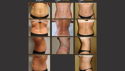 Flatter Stomach & Toner Love Handles Picture 1