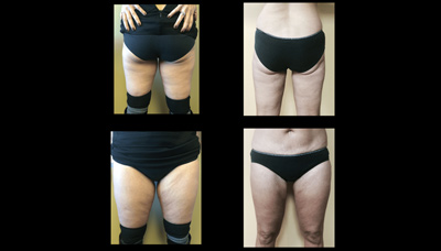 Toner Inner & Outer Thighs