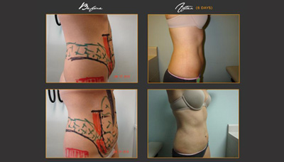 Flatter Stomach & Toner Love Handles Picture 2