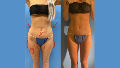 Flatter Stomach & Toner Love Handles Picture 3