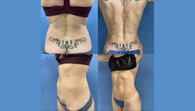 Flatter Stomach Picture 10