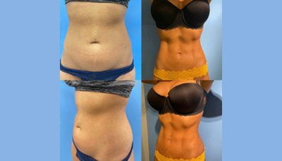Flatter Stomach Picture 13