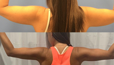 Smartlipo Arms Picture 1