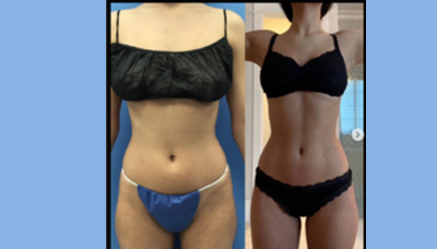 Flatter Stomach Picture 14
