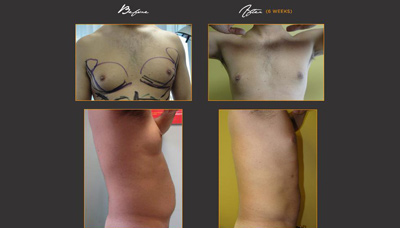 Gyno – Male Breast Reduction Picture 5