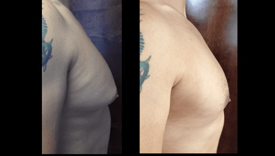Gyno – Severe Male Breast Reduction