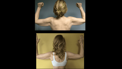 Smartlipo Arms