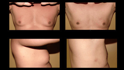 Gyno – Male Breast Reduction Picture 6