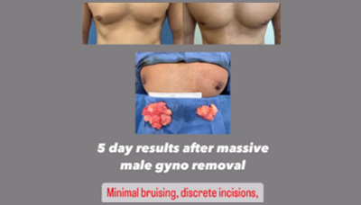 Gyno – Male Breast Reduction  Picture 2