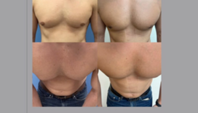Gyno – Male Breast Reduction Picture 3