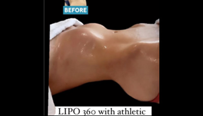 Gyno – Male Breast Reduction Picture 1