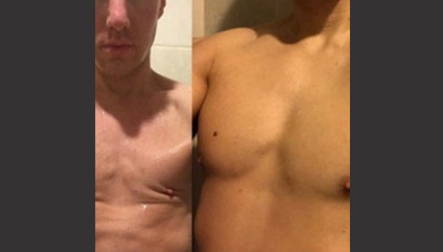 Gyno – Male Breast Reduction Picture 4