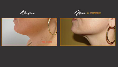 Rejuvenated Face & Neck Picture 4