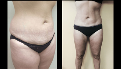 Mommy Make-Over – Anterior Torso & Thighs