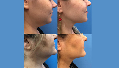 Mother/Daughter Neck Rejuvenation with Smartlipo