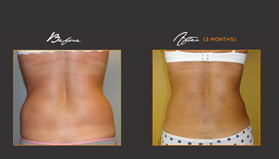 Toner Love Handles Picture 2