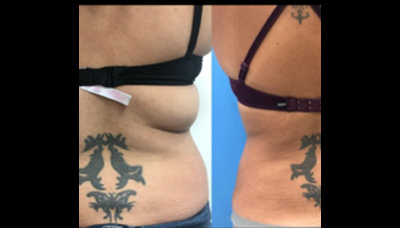 Love Handles & Bra Fat