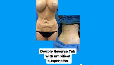 Double Reverse Tuck Picture 2