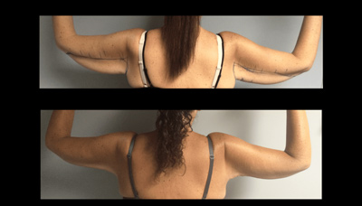 Slimmer Arms Picture 1