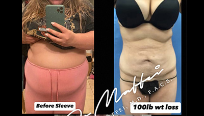 Picture of Tummy Tuck