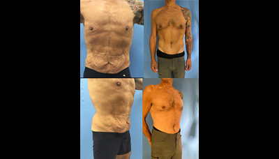 Tummy Tuck
