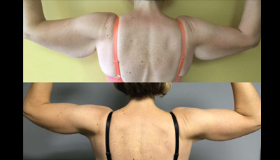 Slimmer Arms Picture 3
