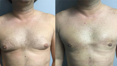 Gyno Picture 2
