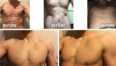 Gyno Picture 3