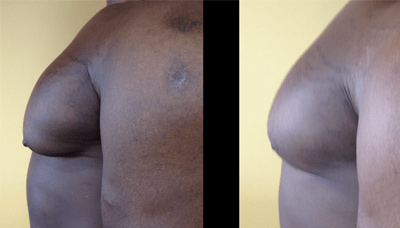 Gyno Picture 4